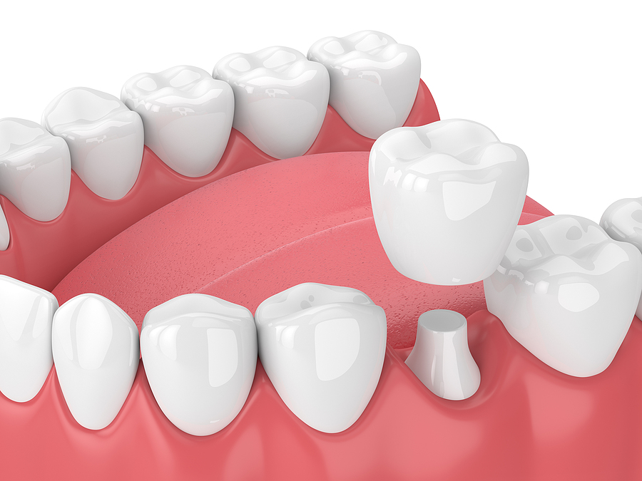 3D Render Of Jaw With Teeth And Dental Crown Restoration