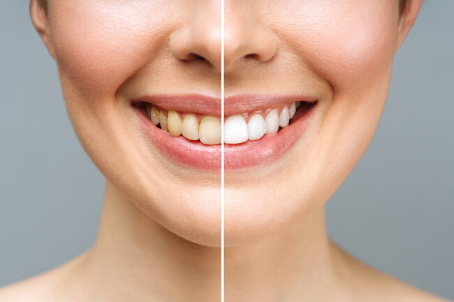 Woman Teeth Before And After Whitening. Over White Background. D