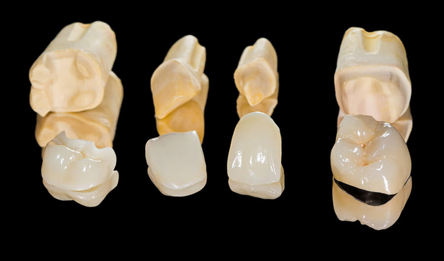 Crowns dental crowns in nw calgary