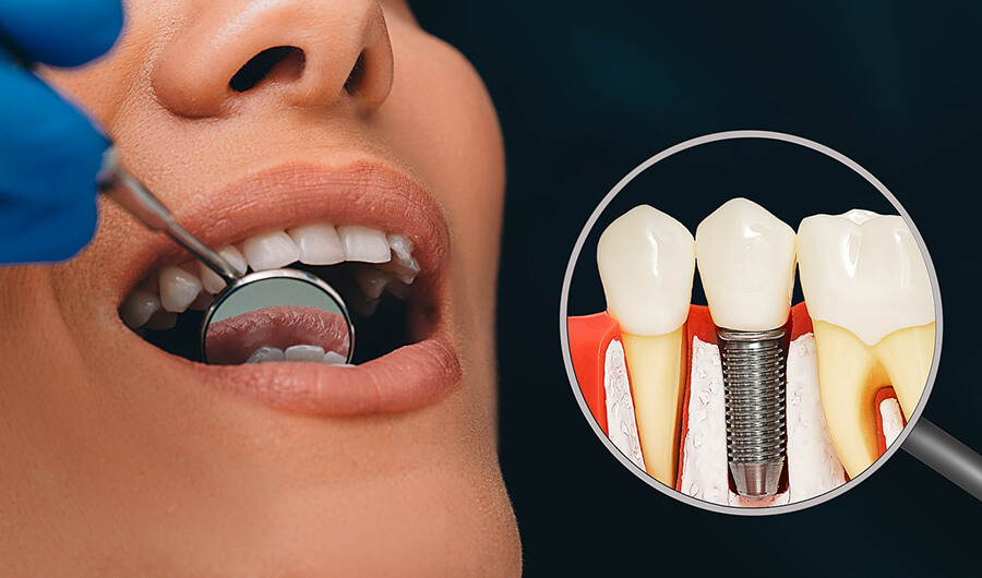 Dental-Implant dental implants in nw calgary