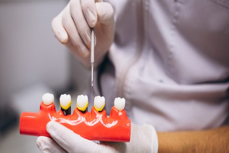 Preparation for a dental bridge on a practice model.