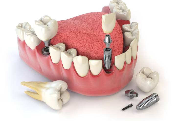 dental implants near me